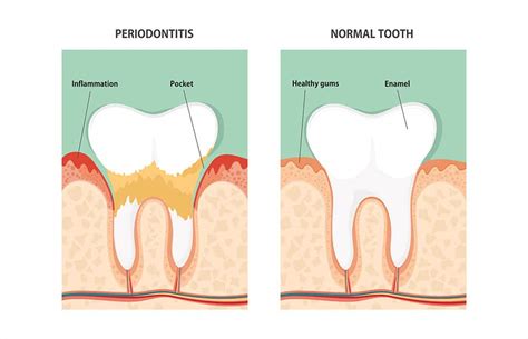 maple grove dentistry|Gum Disease